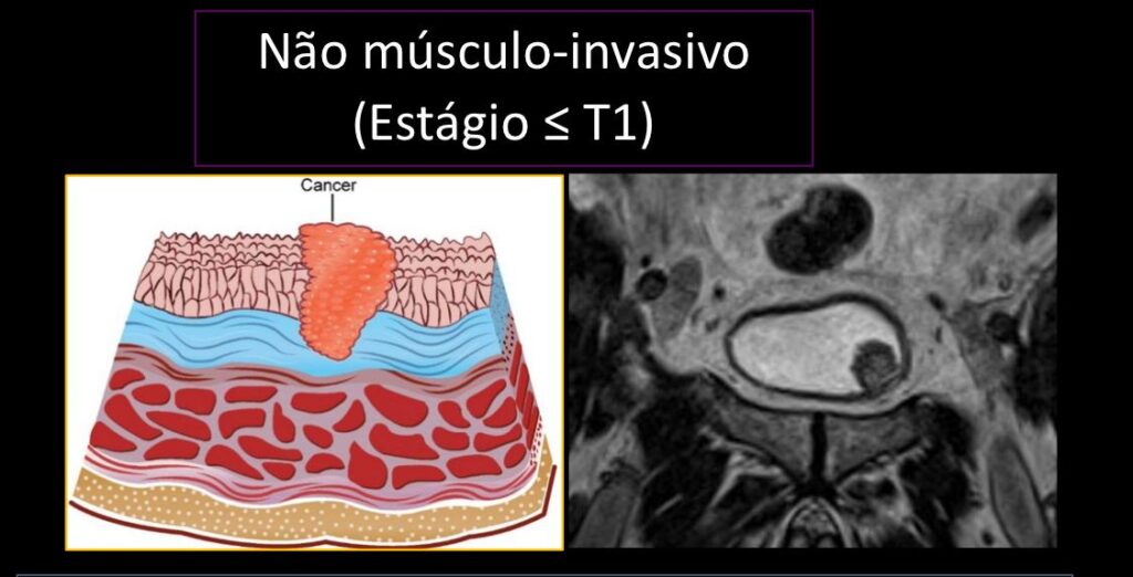 exame de imagem evidenciando um tumor